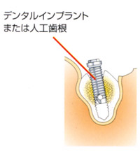 デンタルインプラント