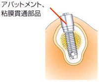 アバットメント連結