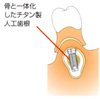 オッセオインテグレーション