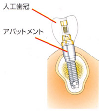 義歯を作る